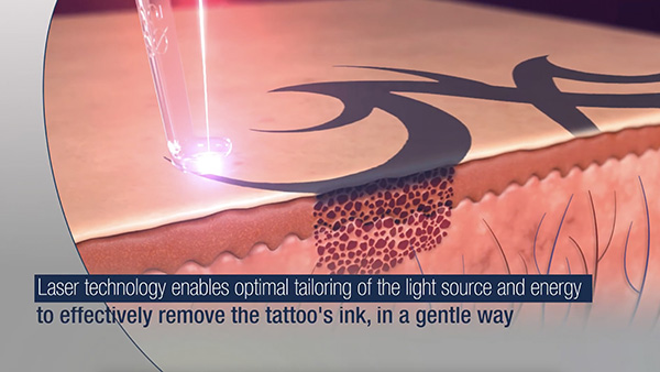 Tattoo removal with Lumenis Stellar M22 laser  London Premier Laser  Skin  Clinic