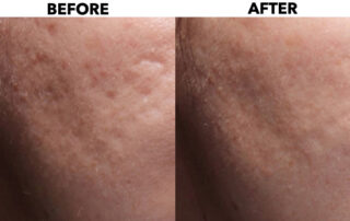Acne-Scars-before-after-total-med-solutions