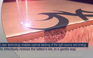 lumenis-q-switched-total-med-solutions