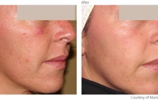 lumenis-resurfx-total-med-solutions