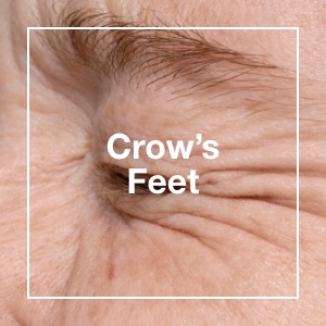 Crow’s Feet