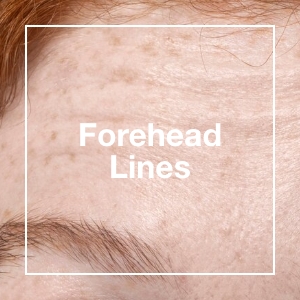 Forehead