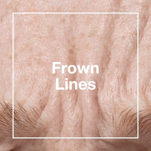 Frown Lines